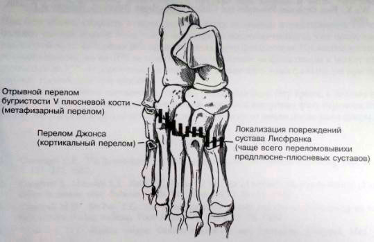 Закрытый перелом стопы карта вызова
